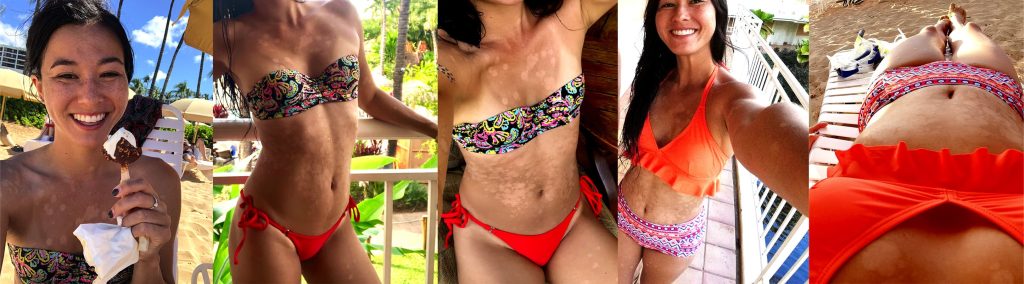 tinea-versicolor-rachel-beach